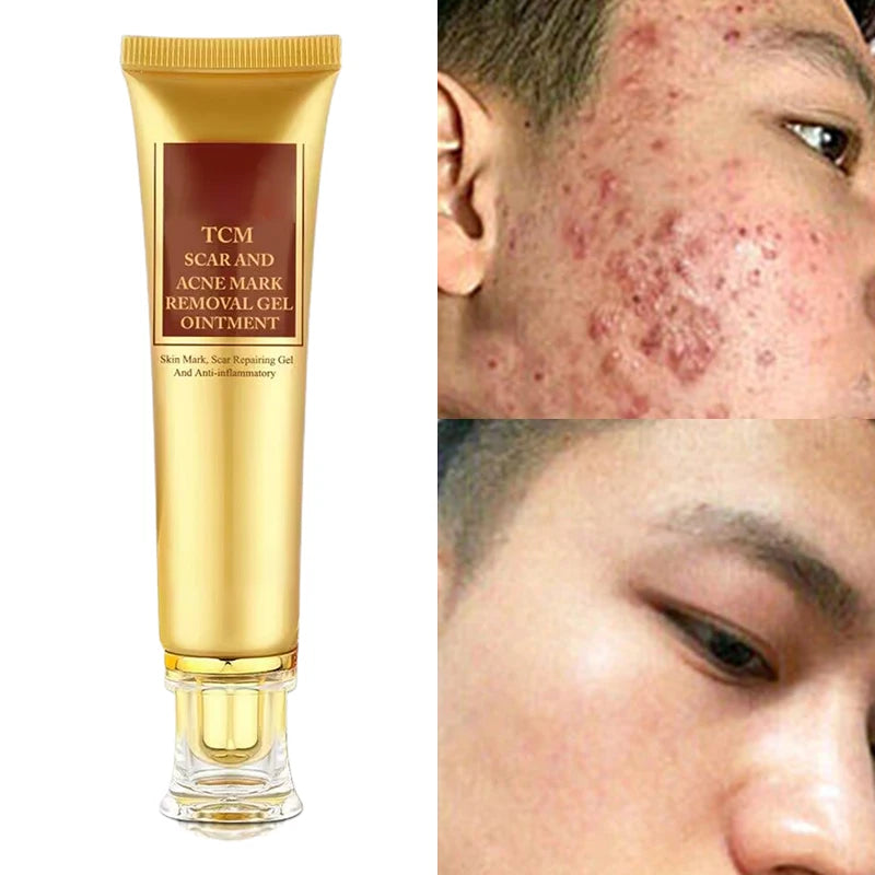 Crème Anti-Vergetures et Anti-Acné-Traitement des Cicatrices (1 acheté = 1 offert)