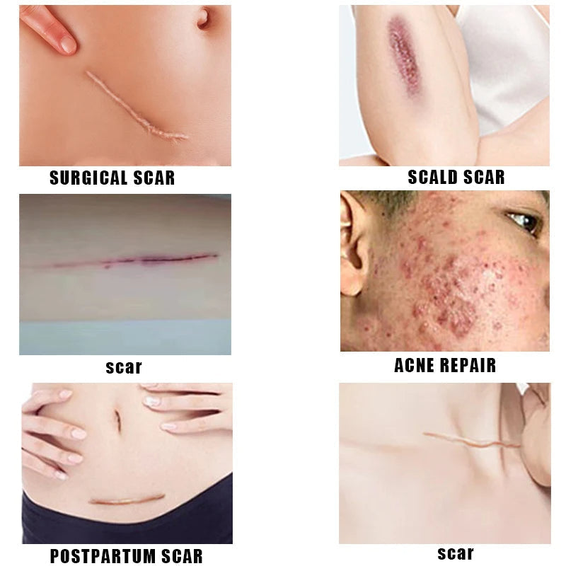 Crème Anti-Vergetures et Anti-Acné-Traitement des Cicatrices (1 acheté = 1 offert)